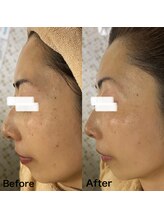 マスカレード(Masquerade)/【クリスティーナ症例写真】