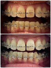 ユーラボ 表参道(YOU-LAB)/Befor/After【ホワイトニング】