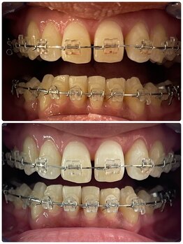 ユーラボ 表参道(YOU-LAB)/Befor/After【ホワイトニング】