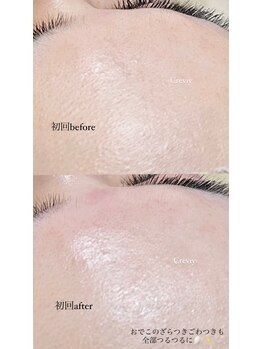 クレヴィー(Creviy)/韓国式3D毛穴洗浄(初回1回目)