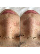 アリクシー(ALIXSY)/毛穴洗浄◎