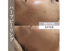 バーグトータルビューティー(bague total beauty)/剥離なしハーブピーリング