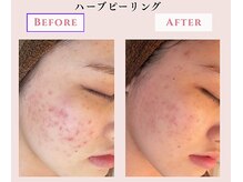 レクラ バイ ドクターエイチ(L'ECLAT by Doctor.H)/ハーブピーリング