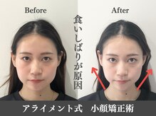 アライメントトウキョウ 麻布十番(Alignment TOKYO)/食いしばりによるエラ張り改善☆