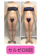 アーク(ARC)/全身痩身120分ビフォーアフター