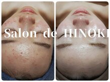 サロン ド ヒノキ(Salon de HINOKI)の雰囲気（跡を残さずニキビケア！大人の肌荒れ改善に自信があります♪）