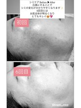 ココ(COCO)/シミケア、ビフォー、アフター