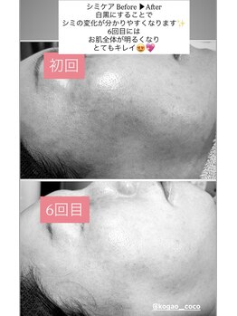 ココ(COCO)/シミケア、ビフォー、アフター