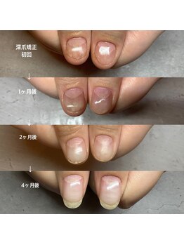 プティット シュシュ(Petit Chouchou)/育爪コース