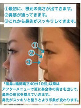 ラプリ 福岡博多店(Raplit)/隆鼻+輪郭・小顔矯正#福岡市博多