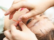 かがしまはりきゅう接骨院 鍼灸整体/美容鍼は電気も流します