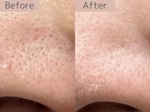 ベアール(beal)/毛穴特化ハーブピーリング1回