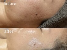 ビビ(Vivi)/毛穴の開きにもハーブピーリング