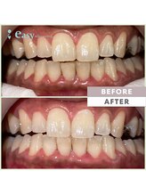 イージーホワイトニング 中野店(easy whitening)/セルフホワイトニング症例写真