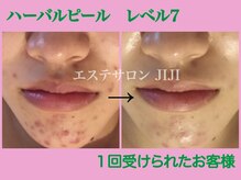 エステサロン ジジ 新宿(JIJI)の雰囲気（ハーバルピール（本格ハーブピーリング）、初回11000円～ /新宿）