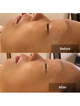 サロンドデュイ/1回施術/40代/ レチノール