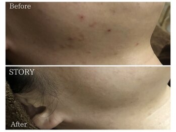 ストーリー 岐阜店(STORY)/ハーブピーリング専門店STORY