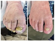 フレッシュフット(FreshFoot)/足のトラブルお任せください