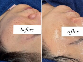 ビパール(bea pull)/韓国ララピール　６回