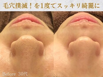 ぷるる 練馬 江古田/30代 毛穴洗浄+美容液導入