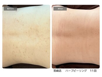 エミルカ 宮崎店(EMILUCA)の写真/【ハーブピーリング&毛穴エクストラクション】メイク、肌見せファッションが楽しくなるスペシャルケア！