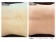 エミルカ 宮崎店(EMILUCA)の写真/【ハーブピーリング&毛穴エクストラクション】メイク、肌見せファッションが楽しくなるスペシャルケア！