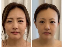 美人バスト 豊橋店/◇小顔症例◇ 【フェイシャル 】
