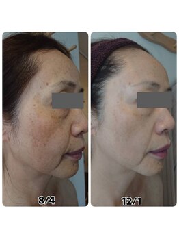 エステサロンブランシュ(Esthe salon Blanche)/ハーブピーリング＋ホームケア