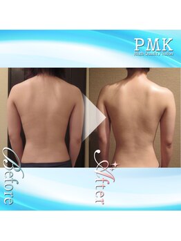 PMK 新宿店/バストUPケア20回(背中)施術