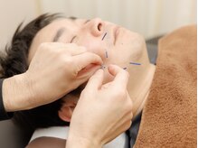 大砂土治療院/メンズ美容鍼　むくみ対策に