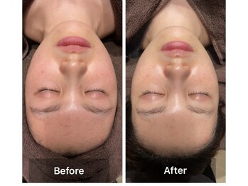 サンタ(SANTA.)/ララピール☆ビフォー&アフター