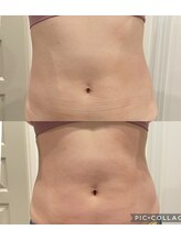 ルナート(Lunart)/腸もみの一回の変化