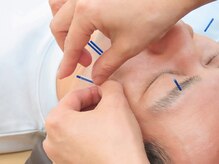 ワセダ接骨鍼灸マッサージ院/美容鍼施術