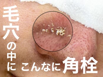 シュリ(Shri)/毛穴撃退コース