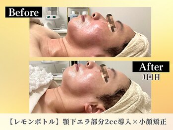 ポーベルポー(Peau Belle poe)/レモンボトル×小顔矯正コラボ