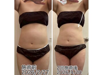 クールスパ(COOL SPA)/40代女性 お腹症例