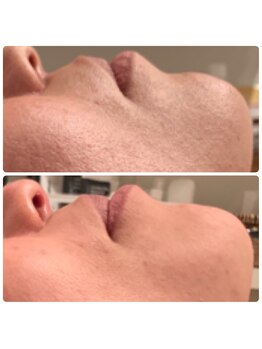 アネランスパ(Anelan Spa.)/ヒト幹細胞で根本から肌質改善