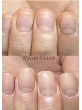 マリーロール 天王寺店(Marie Laure)/自爪育成/深爪矯正/ネイルケア