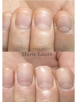 マリーロール 天王寺店(Marie Laure)/自爪育成/深爪矯正/ネイルケア