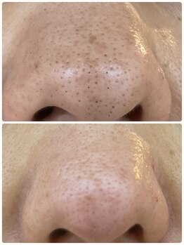 ジェーピーユキノ(jp.yukino)/毛穴洗浄