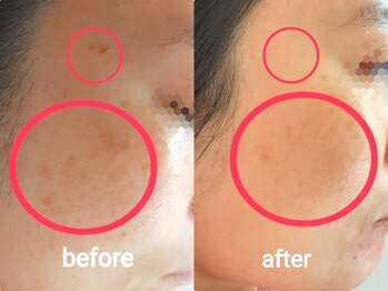 シェリー(Cheri)/【ハーブピーリング剥離無】お顔