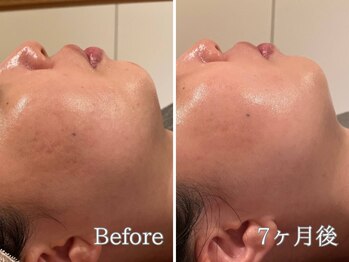 ポポラス(POPOLUS)/凹凸ケア