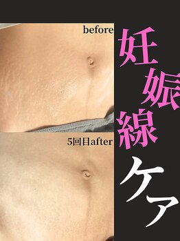 ノーブルノアール(Noble noir)/WINBACKで妊娠線ケア♪