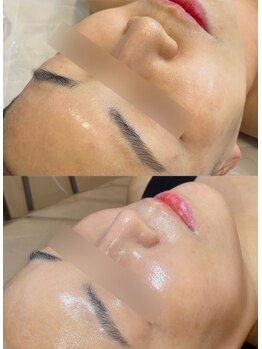 プリエ(Prier)/韓国皮膚科医監修リジュラン導入