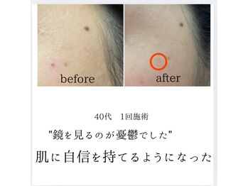 シミリセット 名駅(シミReset)/どんどん増えるシミ・改善