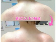 サロンドモモ(SALON de MOMO)/肩のビフォーアフター