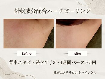 プライベートエステサロン トゥインクル/急な背中ニキビは早めのケアが◎