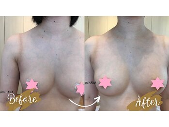 サロンハナ(Salon HANA)/バストの左右差や高さのお悩みに