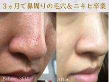 ぷるる 練馬 江古田/30代　ララピール＋毛穴洗浄