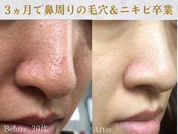 ぷるる 練馬 江古田/30代 ララピール+毛穴洗浄